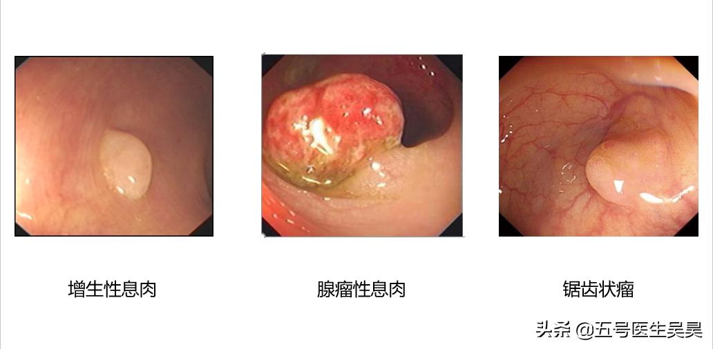 肠道长了息肉怎么办,肠道里的息肉需要处理吗