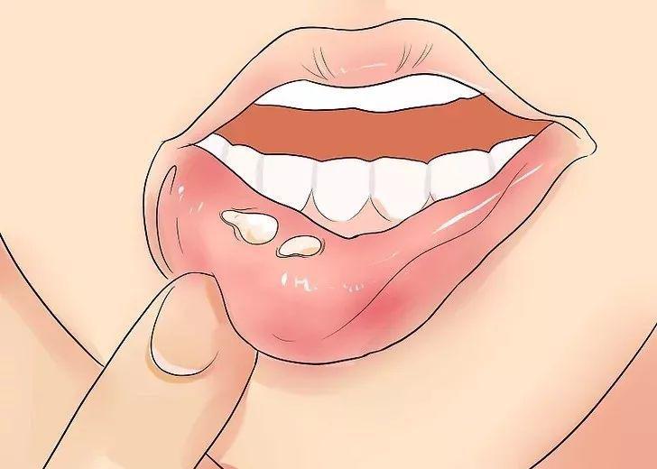 口腔溃疡一定是实火引起的吗,老人经常上火口腔溃疡