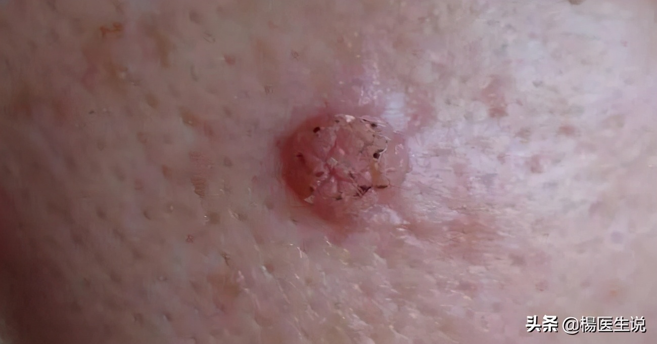 耳朵脖子后面长了个肉瘤叫什么病,脖子上小肉瘤用什么药去除