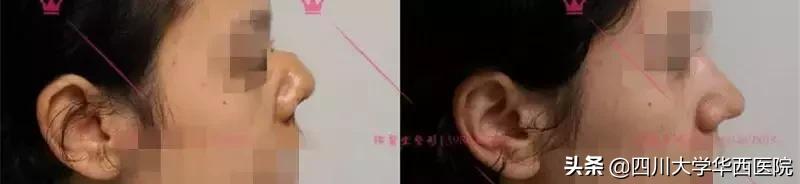 鼻子特别大怎么修,鼻子大如何修鼻子