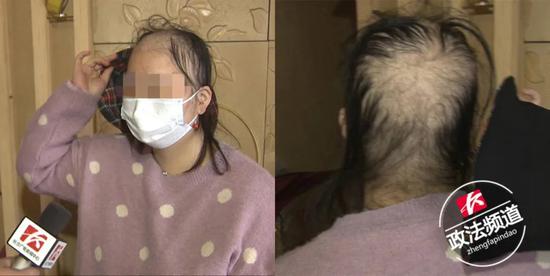 长沙女子做头发护理后变“秃头”店家这么回应