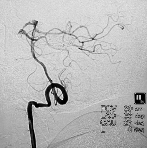 卢旺盛：脉瘤和基底动脉动脉瘤裸栓治疗术后效果非常明显