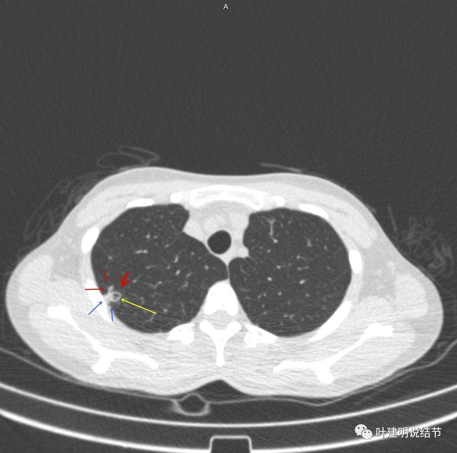 临床诊断孤立性肺结节,空洞型结节一般是什么性质