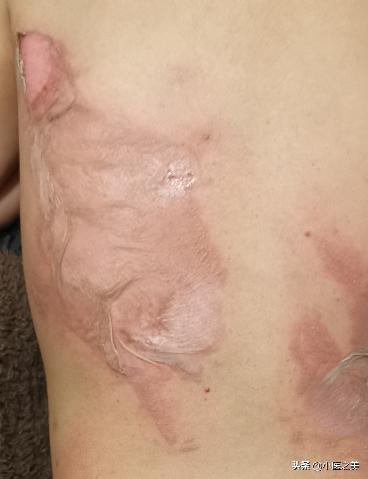 烫伤，以正确的方式治疗可帮助减轻疤痕增生