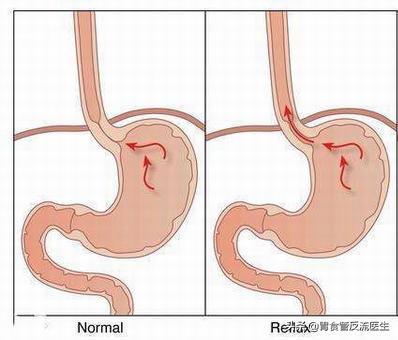 胃食管反流引起咽喉痛怎么治,胃食管反流咽喉痛怎么治疗