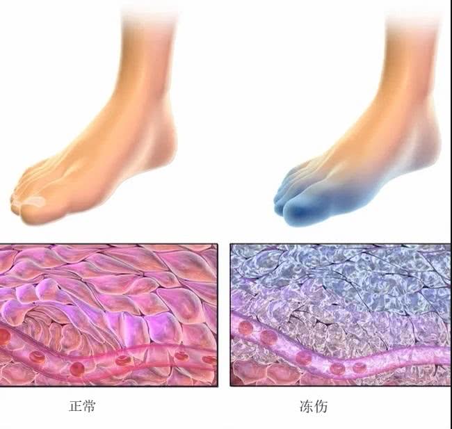 多久能冻死人,冻死会有什么后果