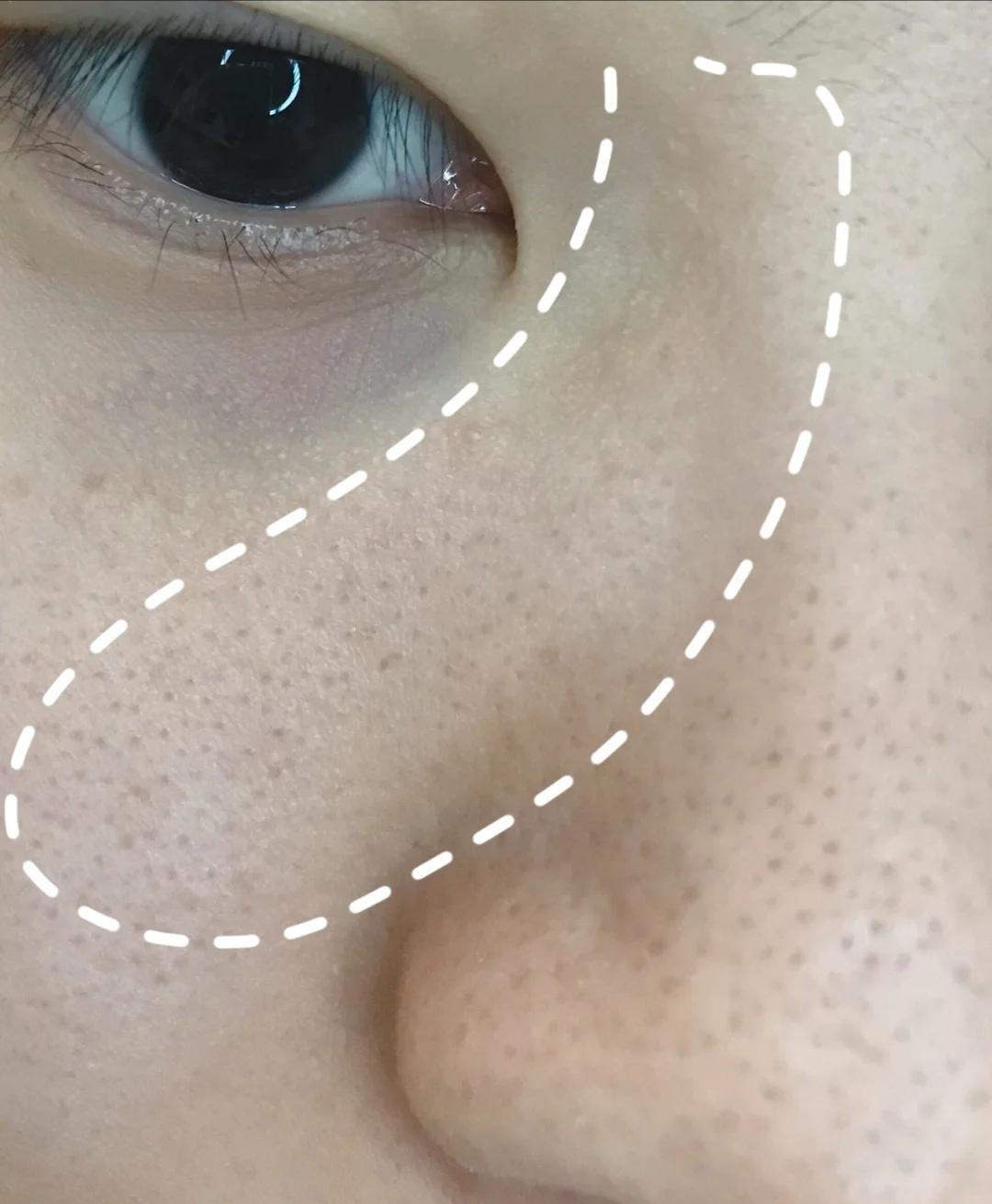 祛痘痘的产品价格多少合适,平价祛痘痘10元以下