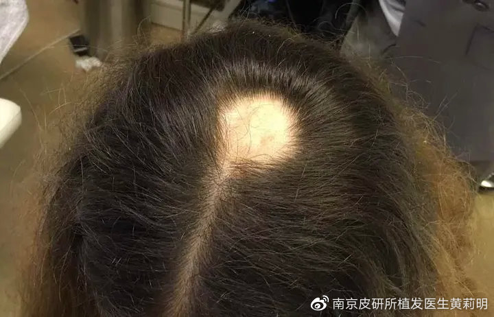 女生二十出头头顶就秃了,我的头秃了怎么办
