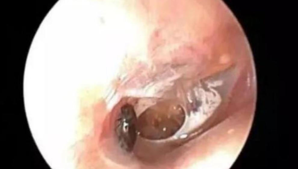 孙女耳朵里意外进飞蛾，奶奶教科书式救助，医生知道后都连连称赞