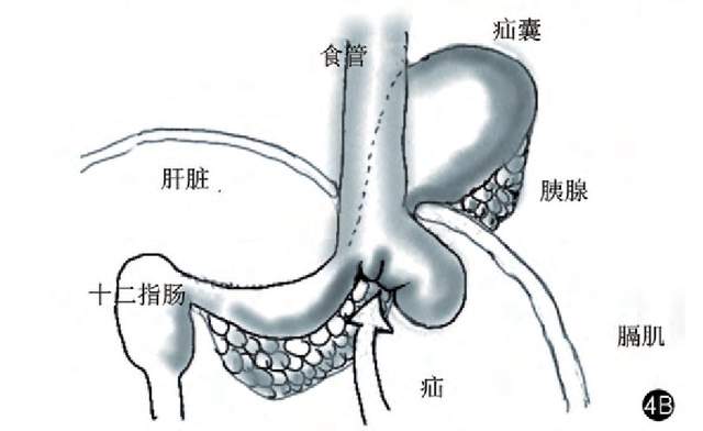 吃过饭就胸闷是冠心病吗,冠心病吃饱了为什么总是胸闷