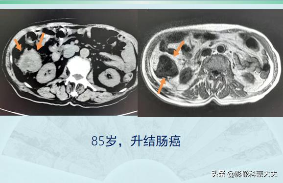 关于便秘的一些事儿,来聊聊便秘