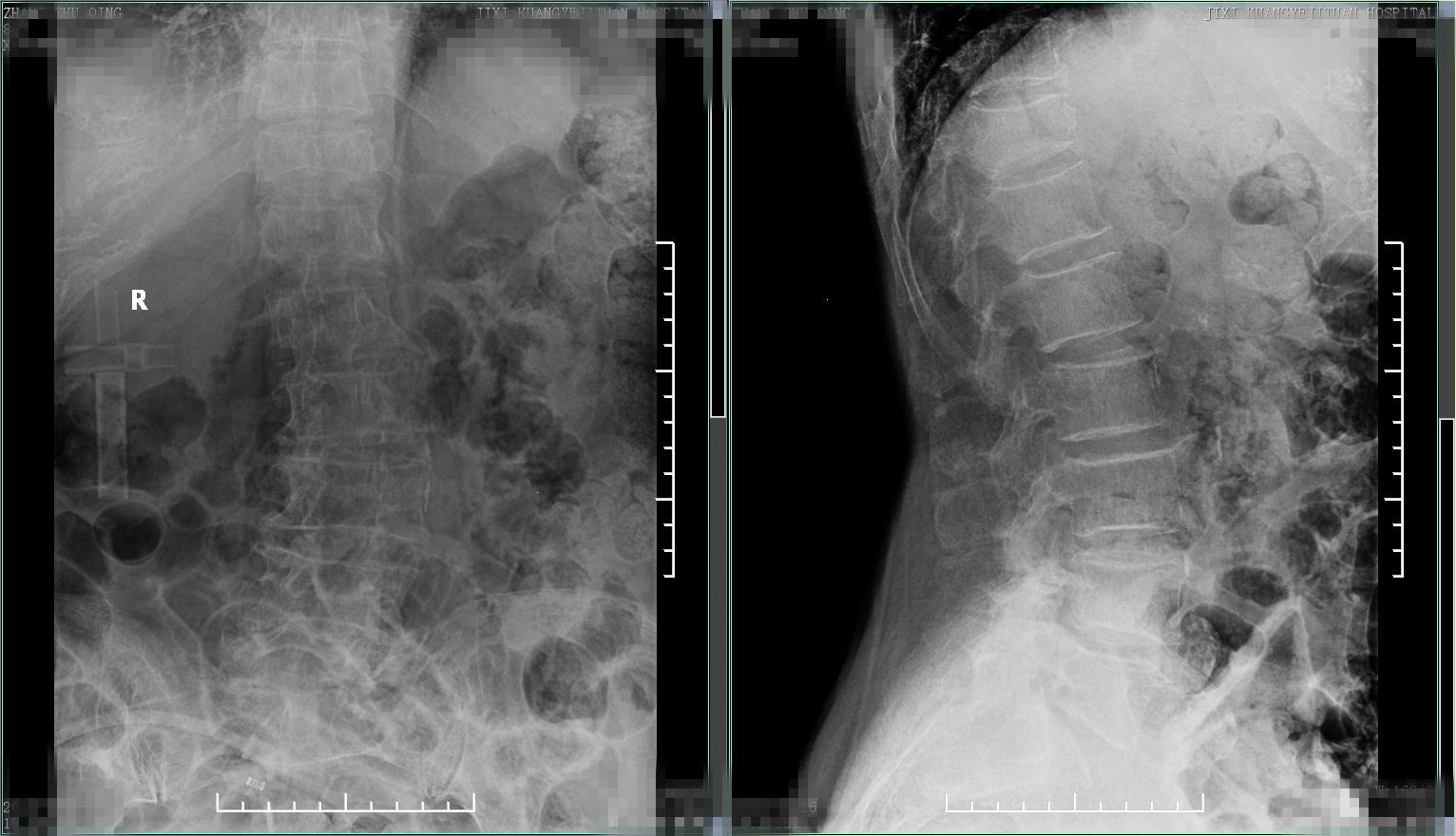 老年人腰腿痛不要忽视,中老年人腰背部酸痛
