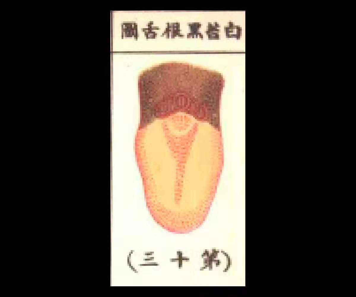 白苔黄厚有齿痕,白苔黑舌