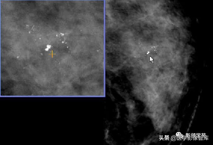 乳腺钙化怎么区分良性和恶性,乳腺钙化的诊断与分级