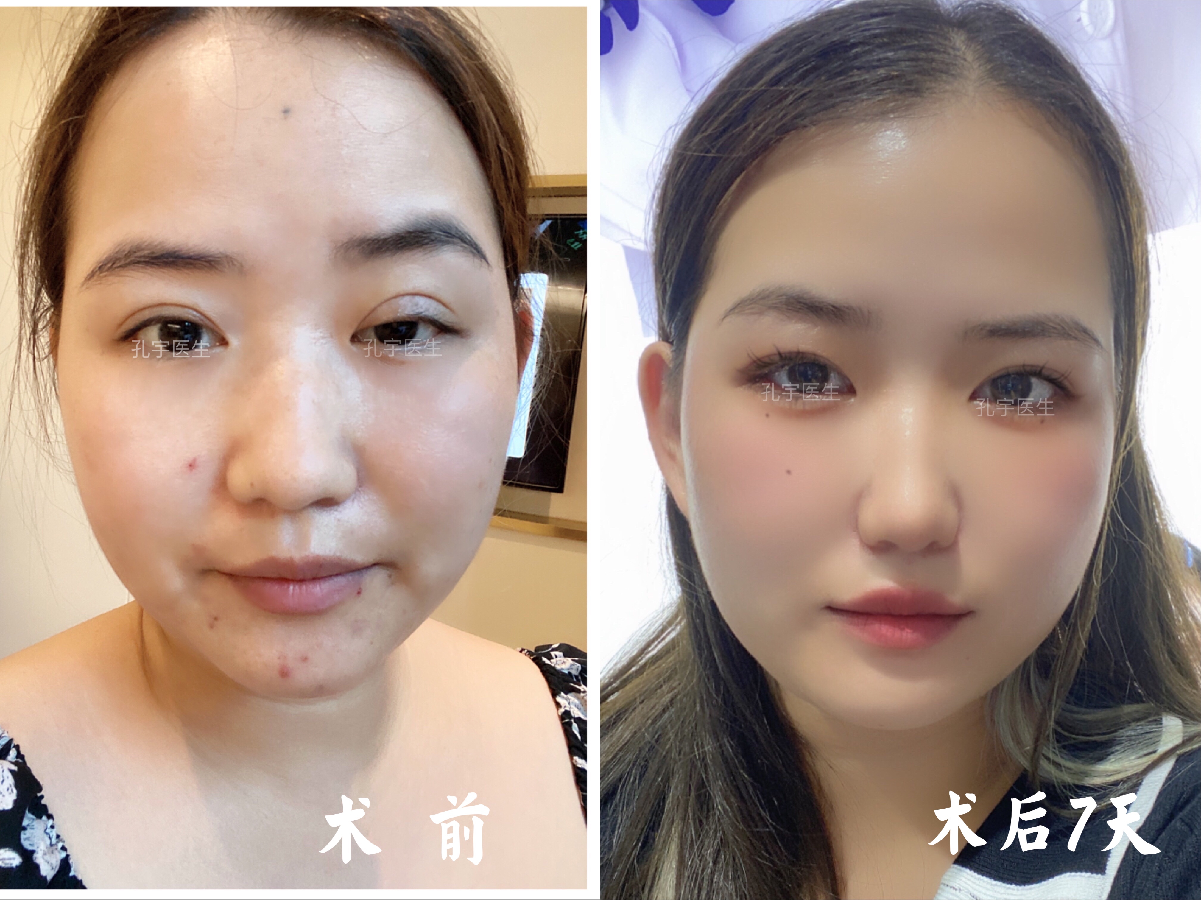 眼睑下垂手术5天恢复图,眼睑下垂手术15天照片