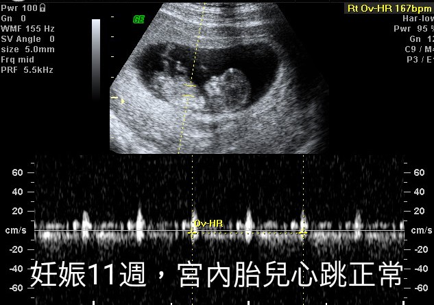 双胞胎一个宫内一个宫外大出血,双胞胎一个流产一个宫外孕