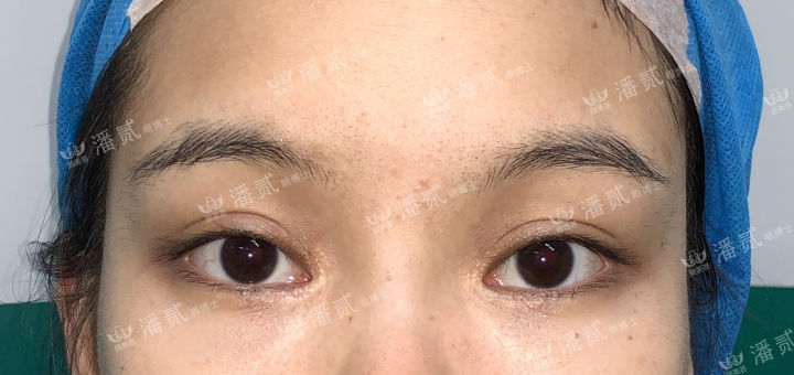 女孩眼部整形失败,内眼角整形失败