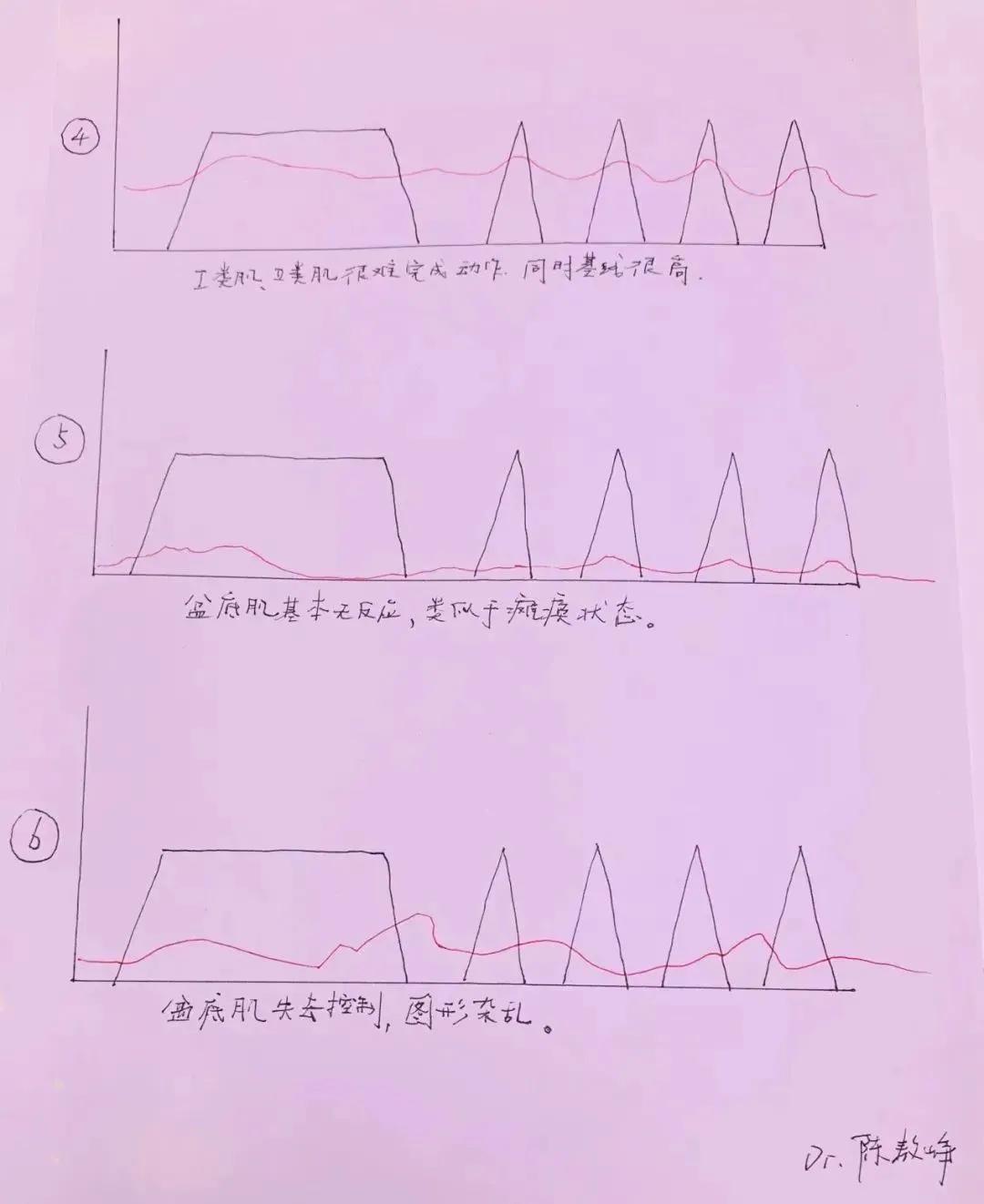 产前自测盆底的正确方法,怎么自测盆底修复是否有效