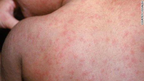 2亿人被它杀死，“灭绝”了20年突然卷土重来！美英法意可能潜伏着一场大危机......