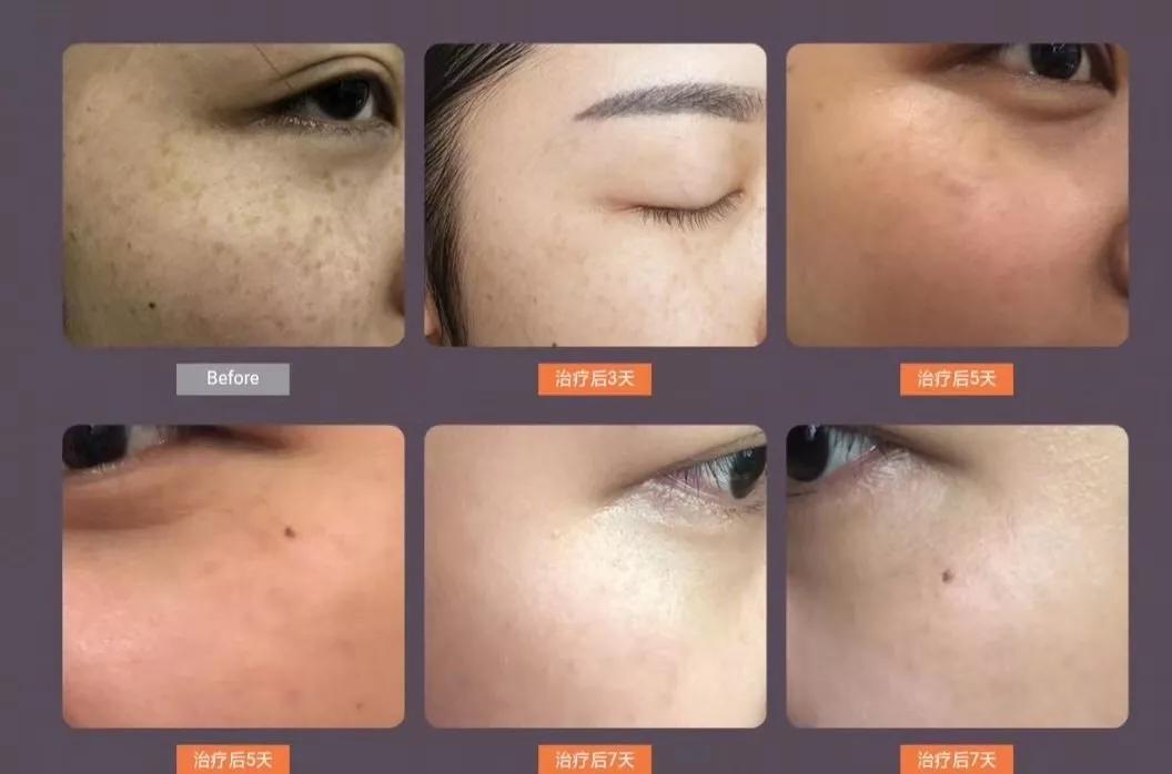 水光针真的比面膜好吗,1次水光等于1000张面膜