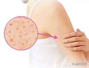 颈部毛囊上长疙瘩图片,大腿小腿毛囊很多红色凸起的小点