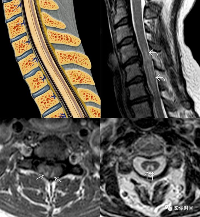 脊髓病变案例图文问诊,脊髓病变视频