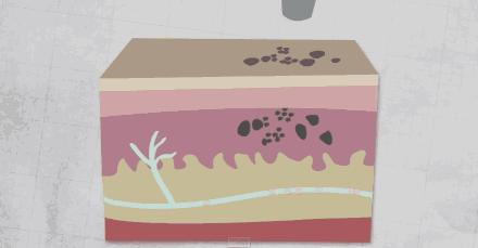 常见的5种激光美容手段，总有一款适合你