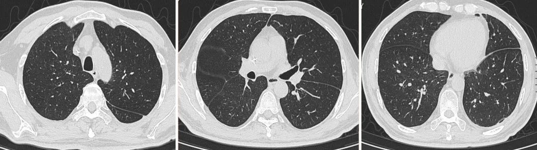 间质性肺病治疗后会加重吗,化疗后肺部间质性的病变