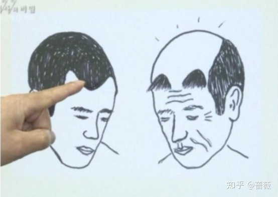 植发后掉光还能植发吗,植发三年后掉光建议雍禾植发