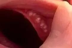 马牙宝宝有什么表现,马牙婴儿怎么治疗