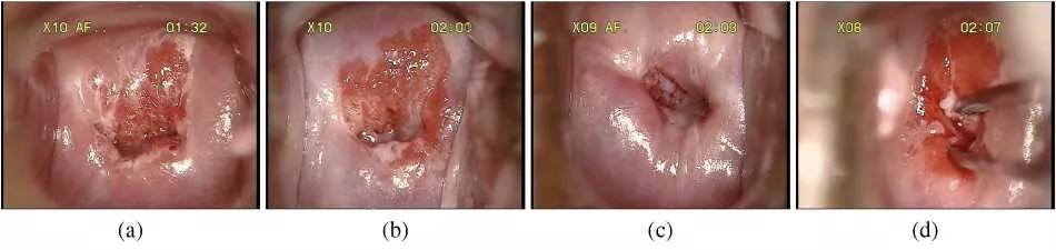 在AI消灭宫颈癌这件事情上,腾讯天衍实验室做了一些重磅研究