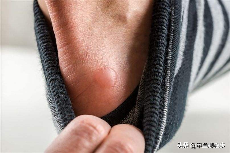 跑步脚起水泡然后破了怎么处理,跑步脚起水泡擦什么药