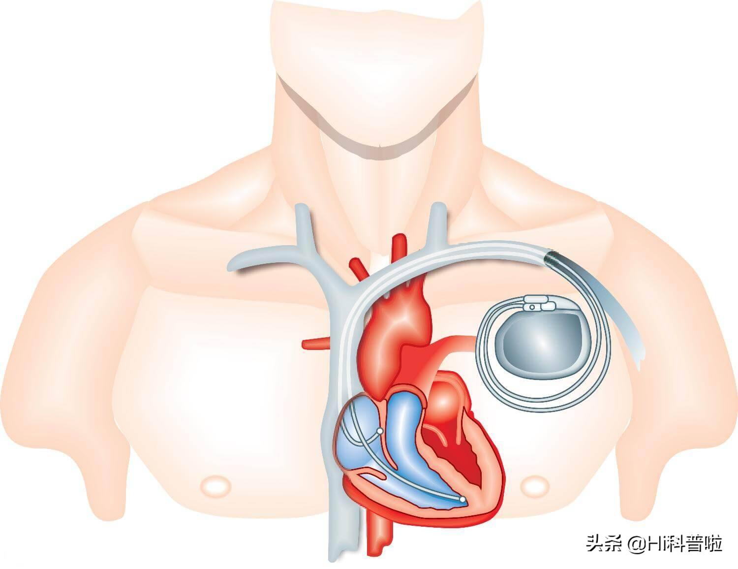 第四代磁悬浮人工心脏人民日报,中国成功研制出磁悬浮心脏了吗