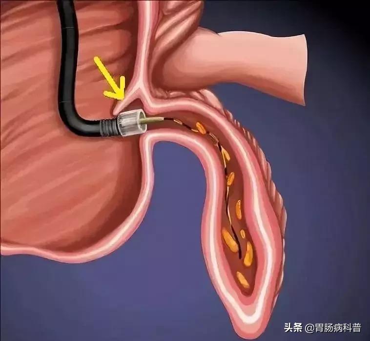 阑尾炎最新内镜微创手术,内镜下阑尾炎治疗术哪里可以做