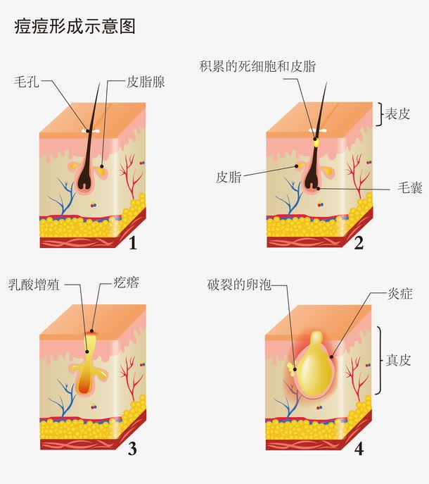 脸上戴口罩闷痘如何快速消除,长期戴口罩闷痘用什么护肤品