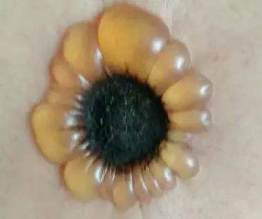 化脓灸怎样灸出疮来,化脓灸是不是把肉灸出疤