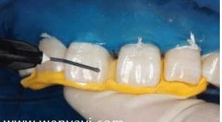 门牙缝可以补吗,门牙有缝怎么办如何补救