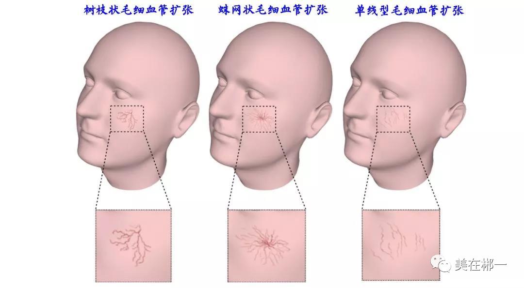 面部布满血丝是否有病,面部皮肤有血丝怎么改善