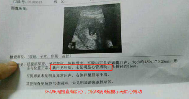 胚胎着床后就胎停了什么原因,胚胎移植后怎么预防胎停