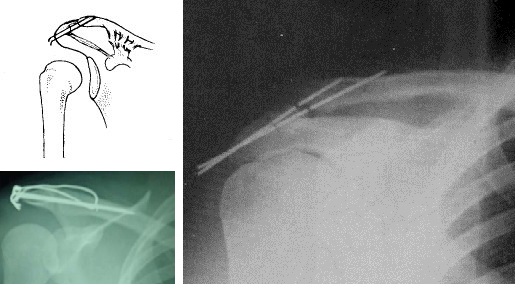 肩锁关节脱位复位视频,肩锁关节脱位固定带