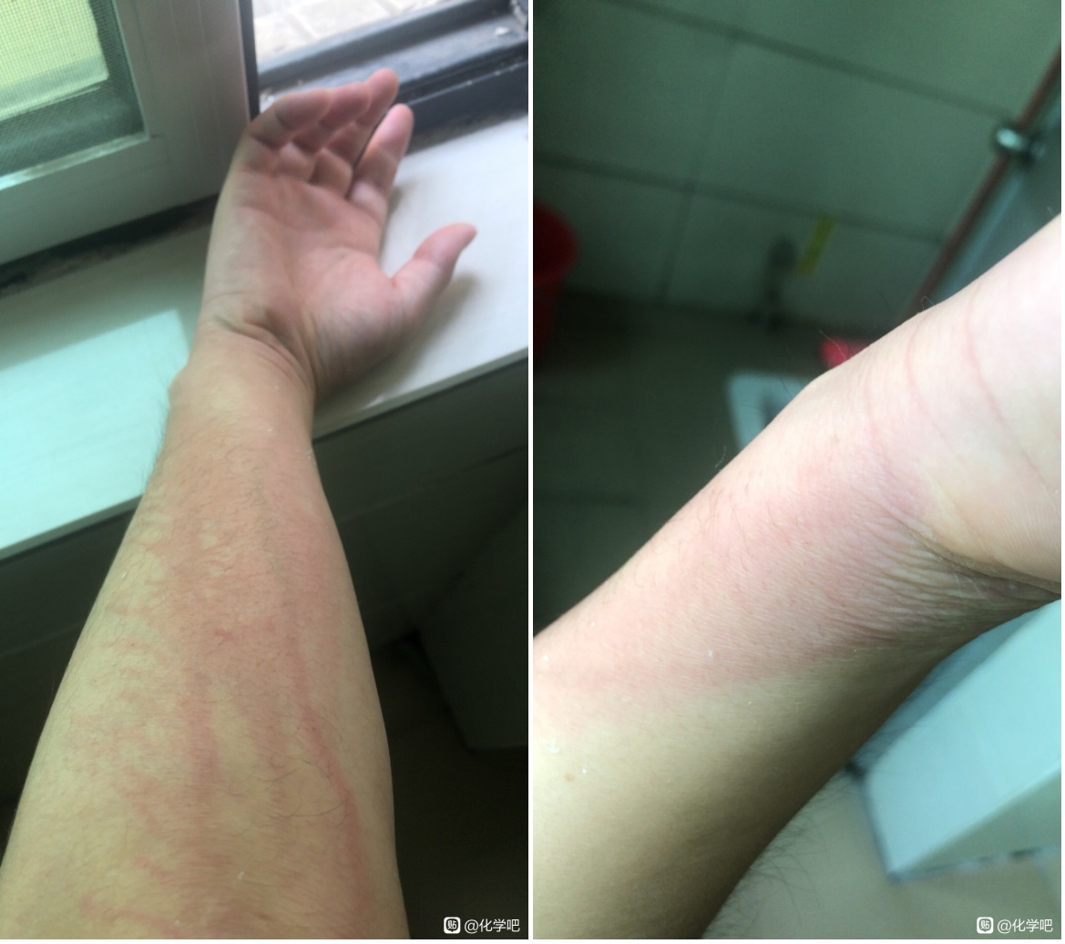 一位老哥在化工厂被氢氟酸弄到了，很多人关心