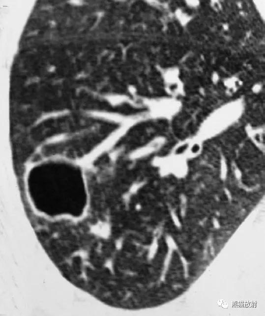 长期卧床病人肺部并发症,卧床患者肺部感染并发症