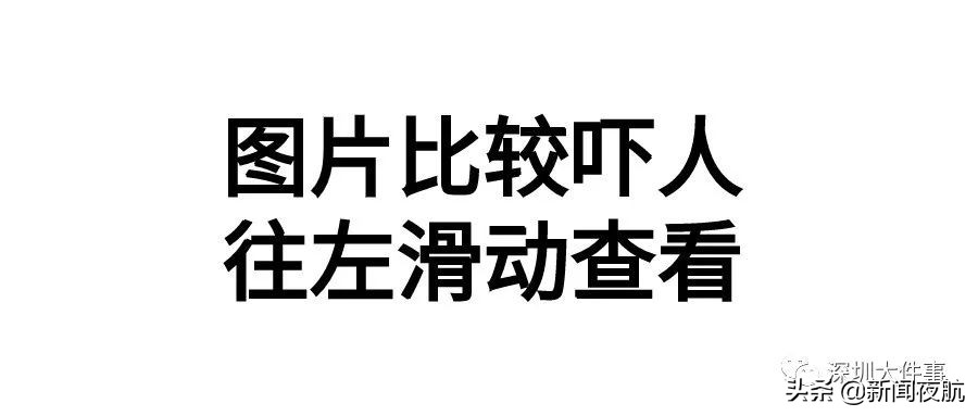 一名女子体内取出3000多颗胆结石,胆结石取出活虫