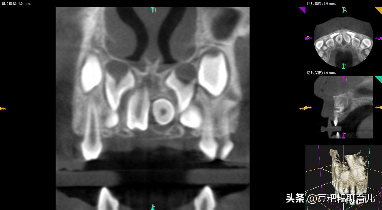 孩子的牙齿疾病之一，越来越多的孩子有“多生牙”，你了解它吗？