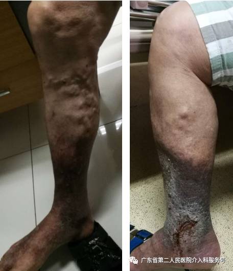 机器引导打针，精准治疗产后静脉曲张