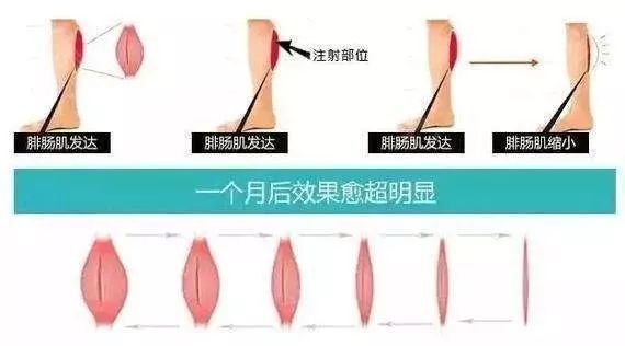 萝卜腿如何瘦下来矫正,萝卜腿怎么减掉