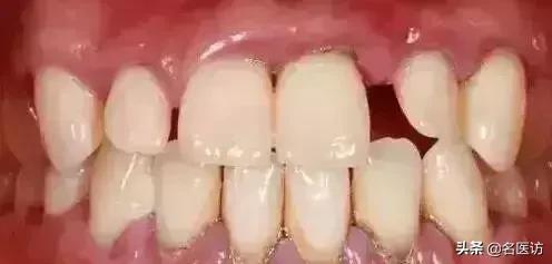 洗牙和牙周刮治区别在哪里,洗牙刚洗好隔天能做牙周刮治吗