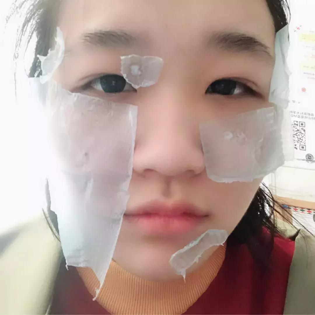 激光祛痣后悔吗,激光祛痣没掉反而更大