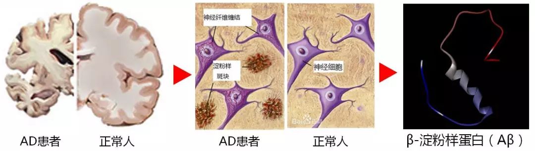 阿尔茨海默病寿命都超不过10年,百年阿尔茨海默病