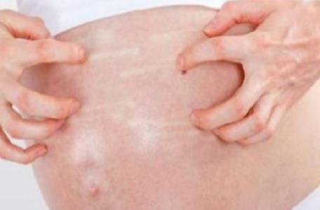 怀孕期间怎么保护皮肤,为什么长妊娠纹皮肤瘙痒